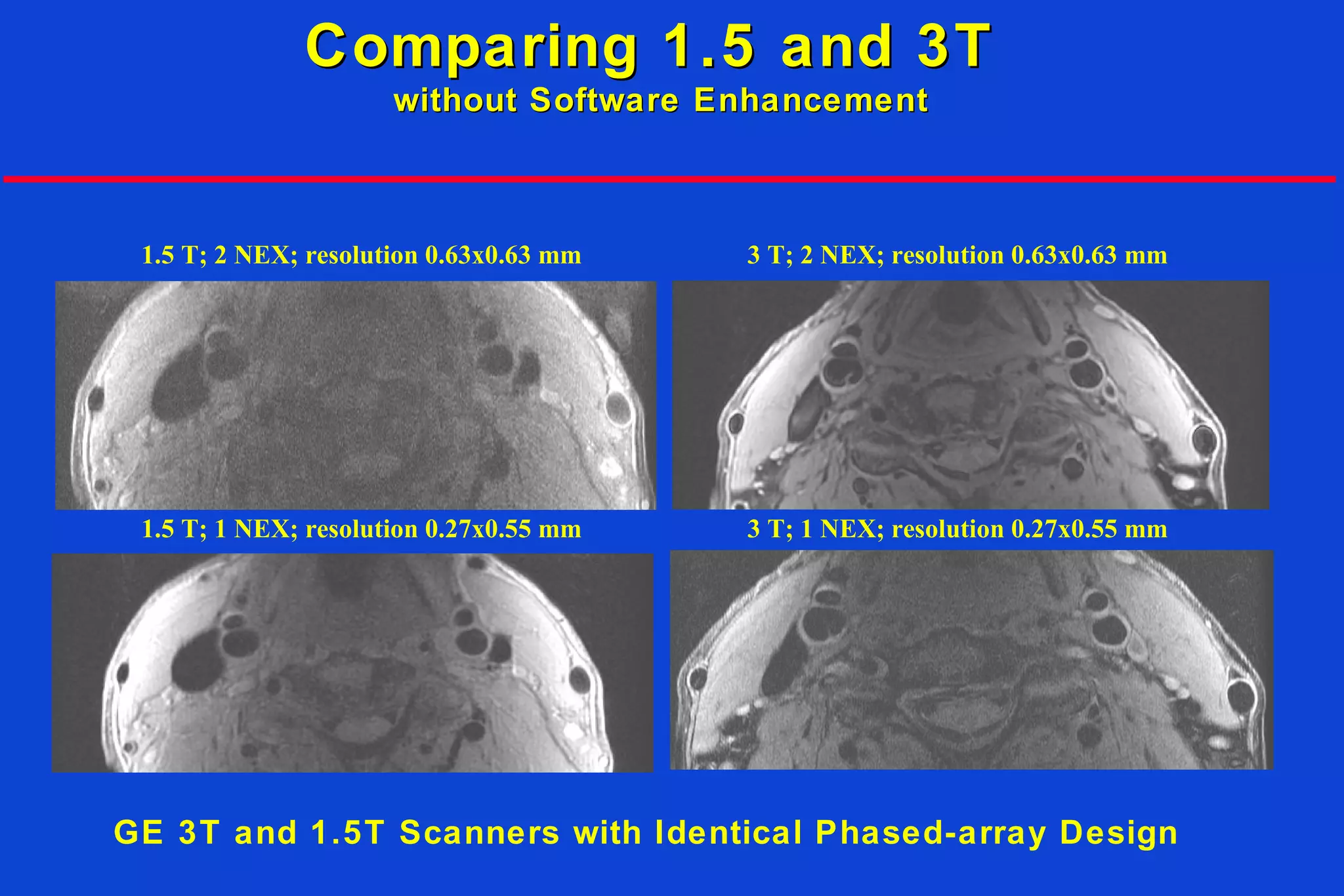 1.5 T; 2 NEX; resolution 0.63x0.63 mm 3 T; 2 NEX; resolution 0.63x0.63 mm
3 T; 1 NEX; resolution 0.27x0.55 mm1.5 T; 1 NEX; resolution 0.27x0.55 mm
Comparing 1.5 and 3TComparing 1.5 and 3T
without Software Enhancementwithout Software Enhancement
GE 3T and 1.5T Scanners with Identical Phased-array Design
 