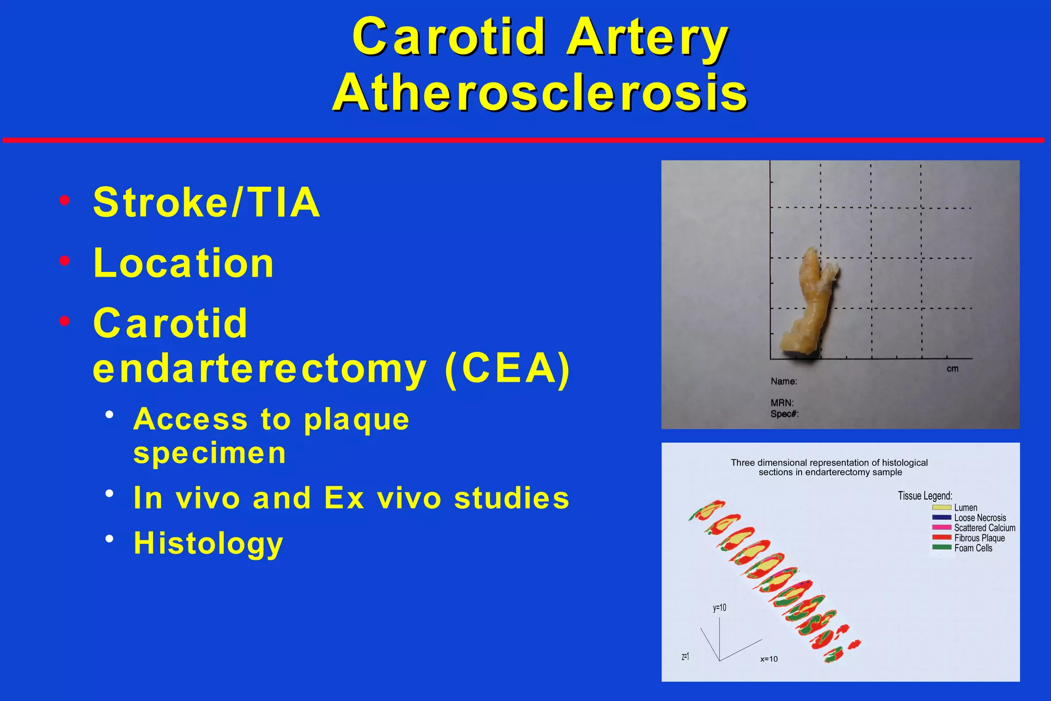 Carotid ArteryCarotid Artery
AtherosclerosisAtherosclerosis
• Stroke/TIA
• Location
• Carotid
endarterectomy (CEA)
• Access to plaque
specimen
• In vivo and Ex vivo studies
• Histology
 