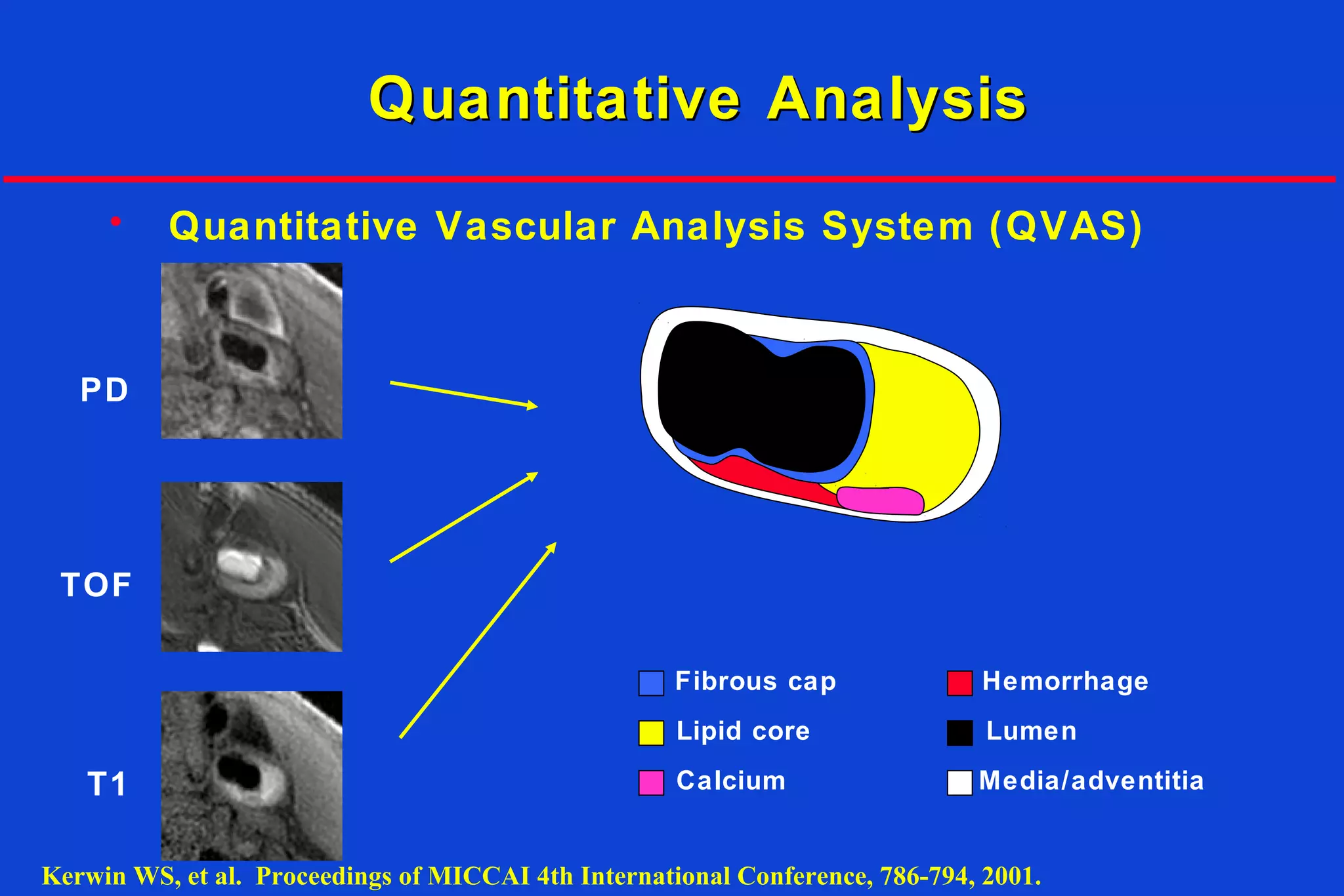 Quantitative AnalysisQuantitative Analysis
• Quantitative Vascular Analysis System (QVAS)
PD
T1
TOF
Fibrous cap
Lipid core
Calcium Media/adventitia
Lumen
Hemorrhage
Kerwin WS, et al. Proceedings of MICCAI 4th International Conference, 786-794, 2001.
 