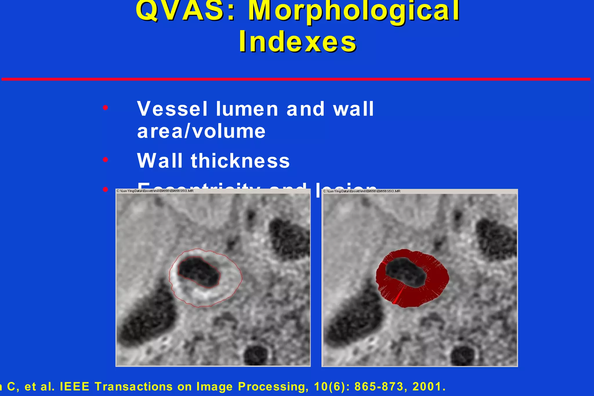 QVAS: MorphologicalQVAS: Morphological
IndexesIndexes
• Vessel lumen and wall
area/volume
• Wall thickness
• Eccentricity and lesion
distribution
n C, et al. IEEE Transactions on Image Processing, 10(6): 865-873, 2001.
 