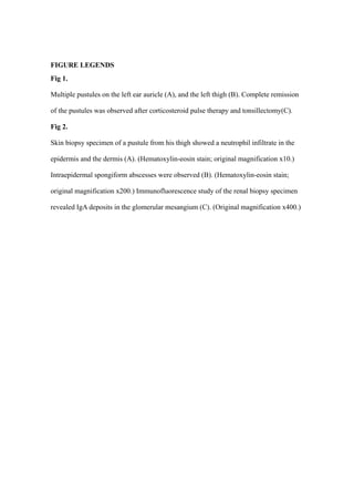 FIGURE LEGENDS
Fig 1.
Multiple pustules on the left ear auricle (A), and the left thigh (B). Complete remission
of the pustules was observed after corticosteroid pulse therapy and tonsillectomy(C).
Fig 2.
Skin biopsy specimen of a pustule from his thigh showed a neutrophil infiltrate in the
epidermis and the dermis (A). (Hematoxylin-eosin stain; original magnification x10.)
Intraepidermal spongiform abscesses were observed (B). (Hematoxylin-eosin stain;
original magnification x200.) Immunofluorescence study of the renal biopsy specimen
revealed IgA deposits in the glomerular mesangium (C). (Original magnification x400.)
 