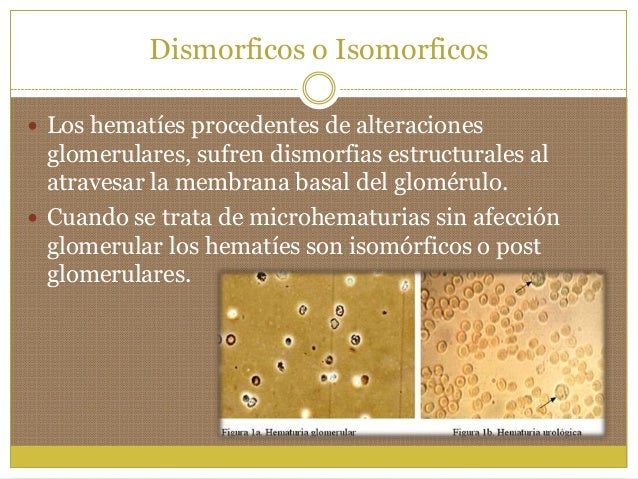 Leucocitos Generalmente hasta 5 porcampo, PMN. Proceso infeccioso oinflamatorio del Riñón yTU. Descartar origen vaginal...