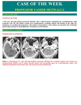 CASE OF THE WEEK
                  PROFESSOR YASSER METWALLY
CLINICAL PICTURE

CLINICAL PICTURE

A 60 years old male patient presented clinically with a clinical picture simulating the cerebellopontine angle
syndrome with 7th, 5th, bulbar cranial nerve manifestations, cerebellar deficits and tinnitus in the right ear.
Symptoms are gradual and progressive. The patient is hypertensive, with evidence of concentric left ventricular
hypertrophy and type IV hyperlipidemia. The patient was not diabetic.

RADIOLOGICAL FINDINGS

RADIOLOGICAL FINDINGS  




Figure 1. Postcontrast CT scan showing fusiform aneurysm affecting the vertebral arteries, the arteries are
asymmetrically dilated, oval in shape, laterally placed and encroaching upon the cerebellopontine angle, with
significant indentation of the brain stem. Also notice the mural calcification.
 