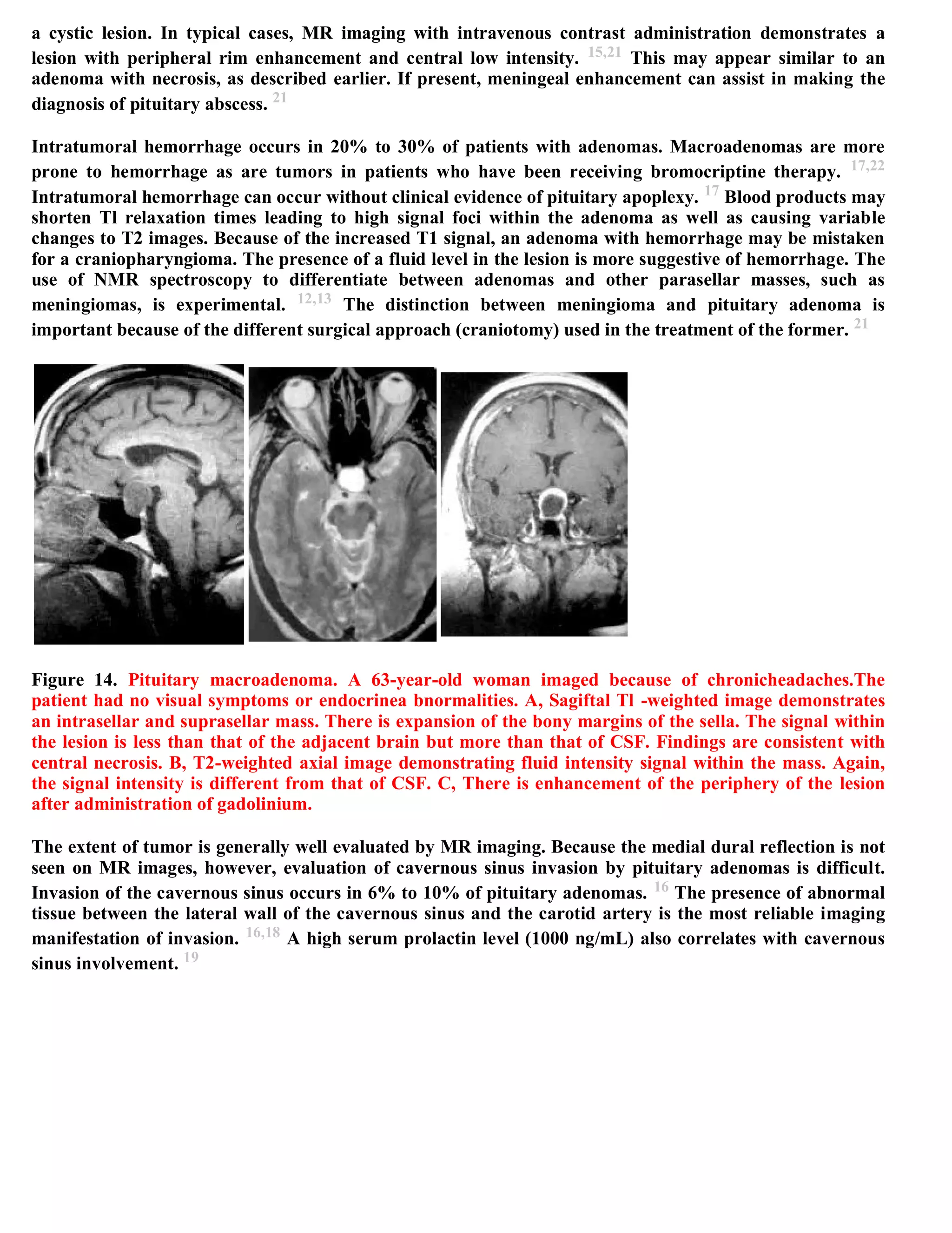 Topic of the month...Neuroimaging of pituitary adenomas