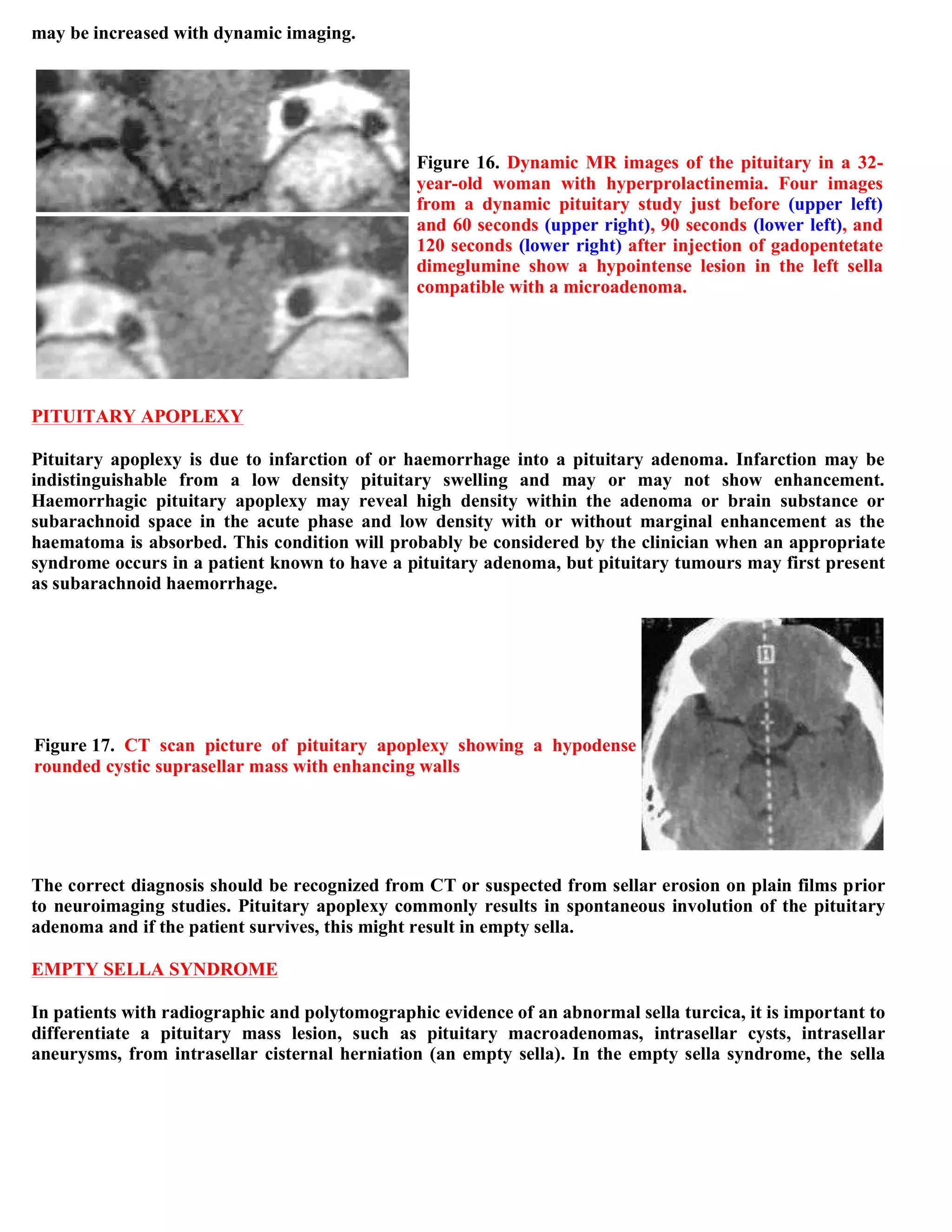 Topic of the month...Neuroimaging of pituitary adenomas