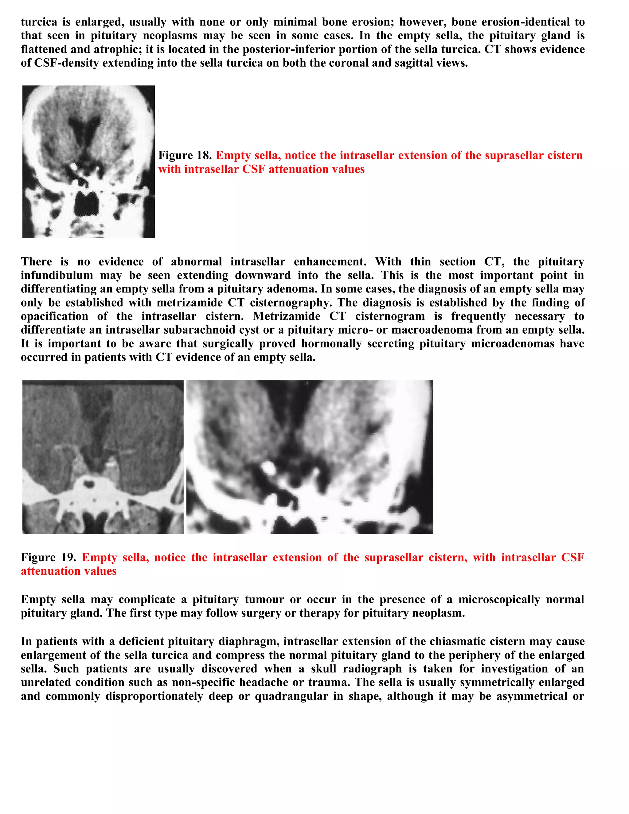 Topic of the month...Neuroimaging of pituitary adenomas