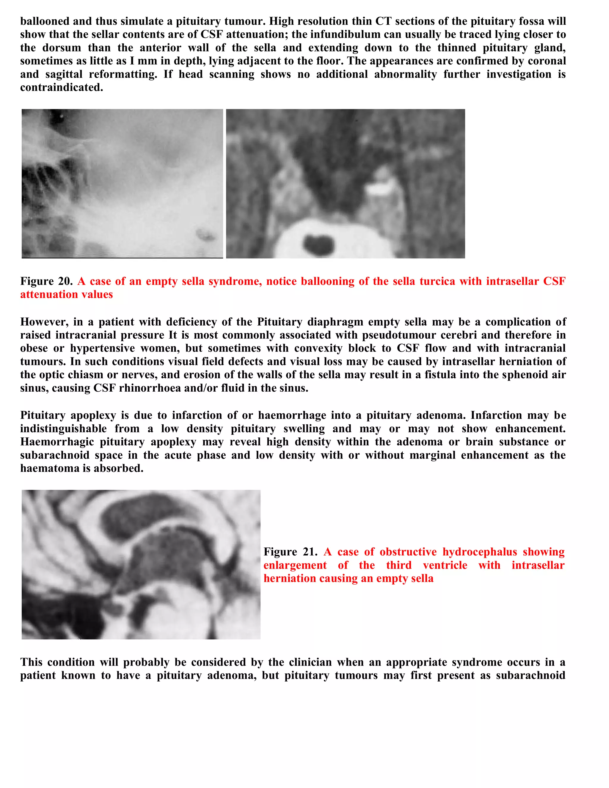Topic of the month...Neuroimaging of pituitary adenomas