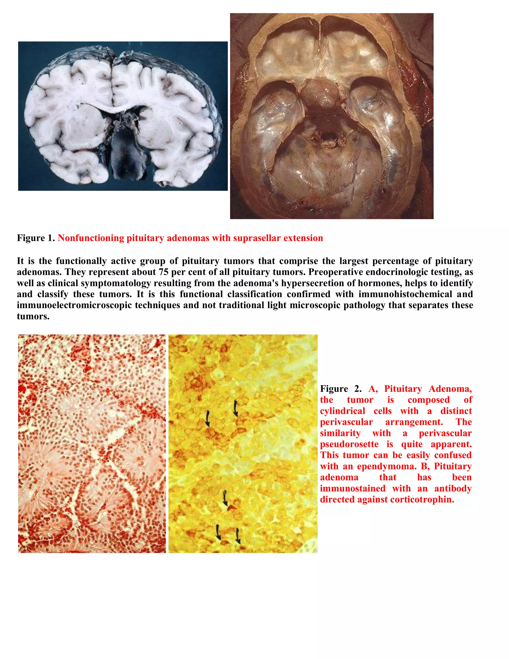 Topic of the month...Neuroimaging of pituitary adenomas