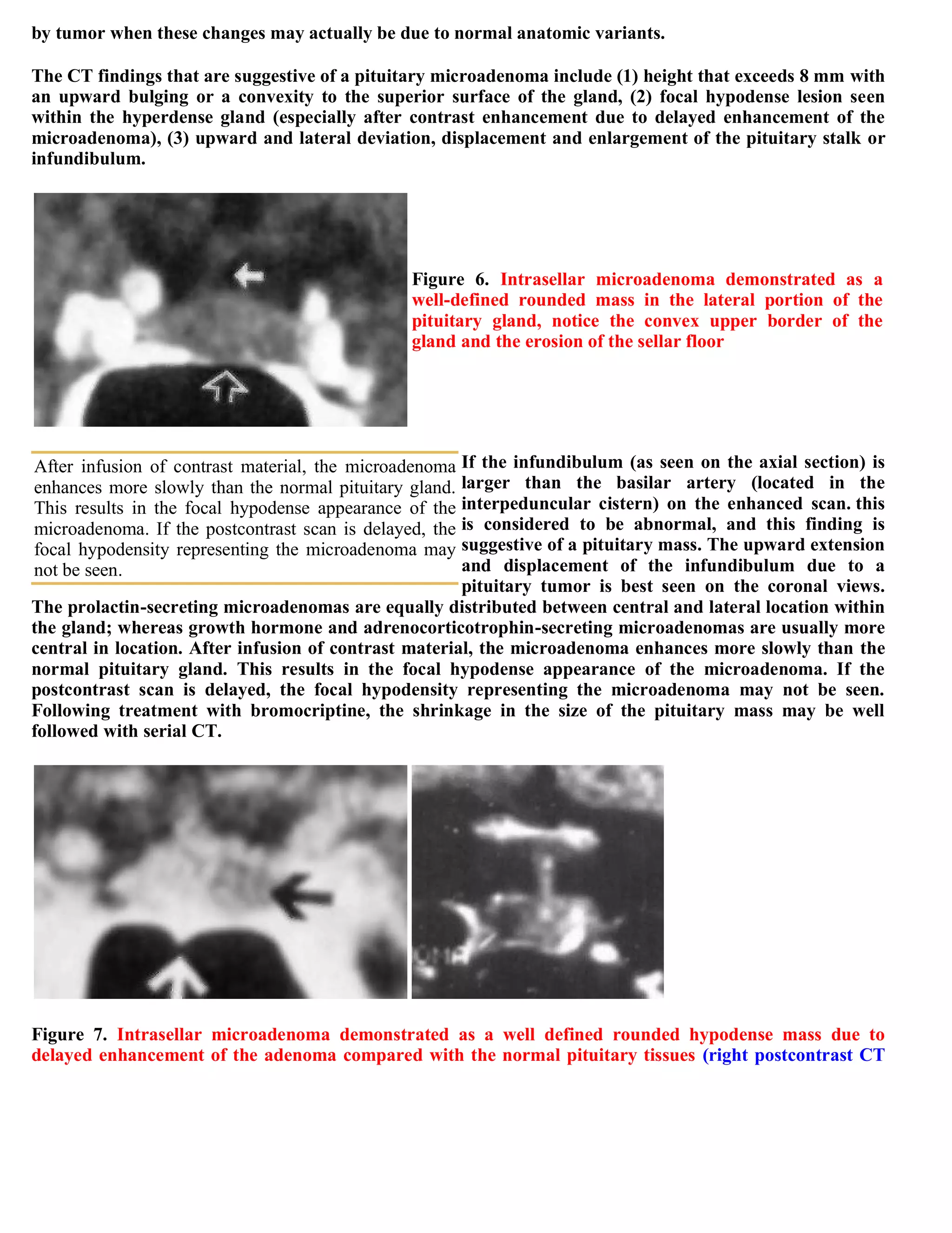 Topic of the month...Neuroimaging of pituitary adenomas