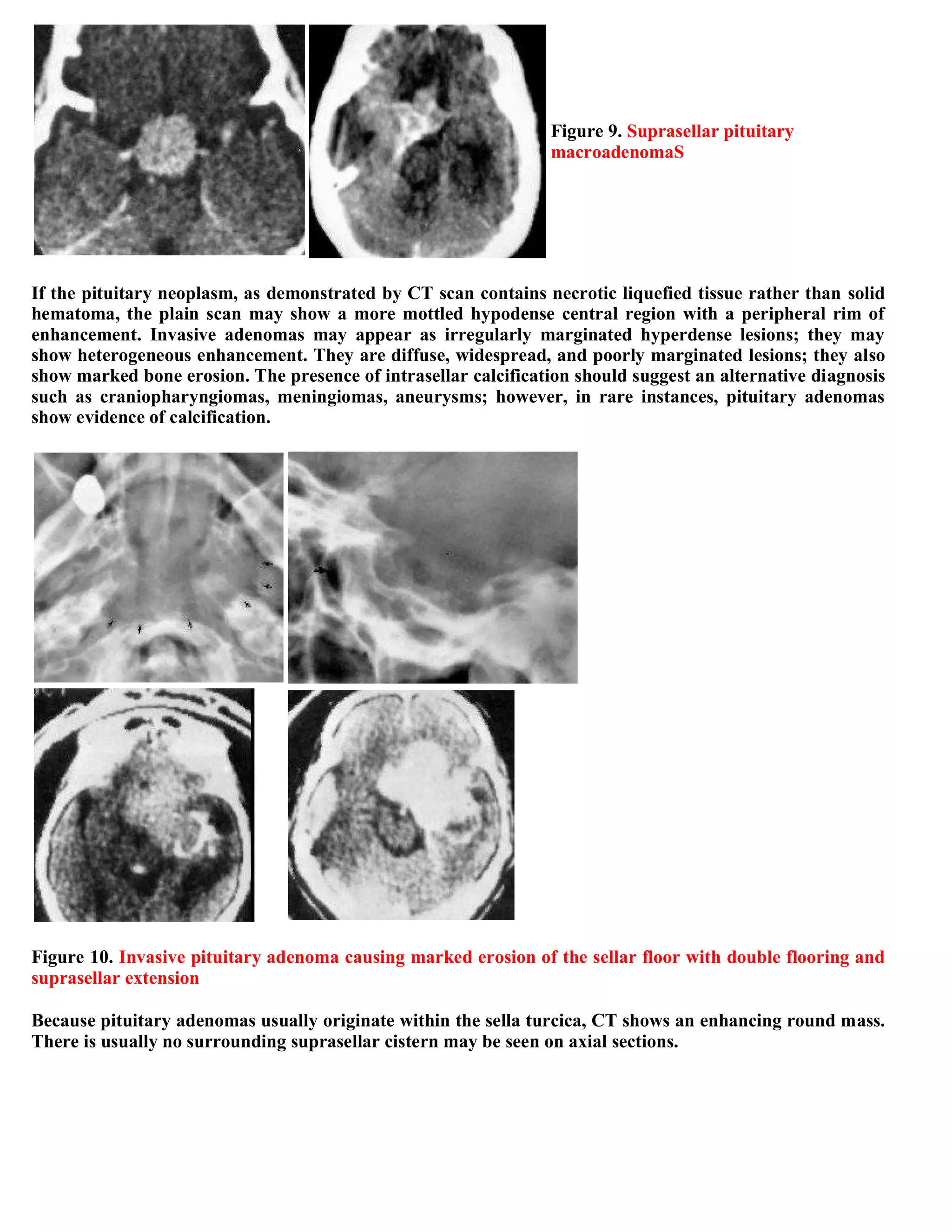 Topic of the month...Neuroimaging of pituitary adenomas
