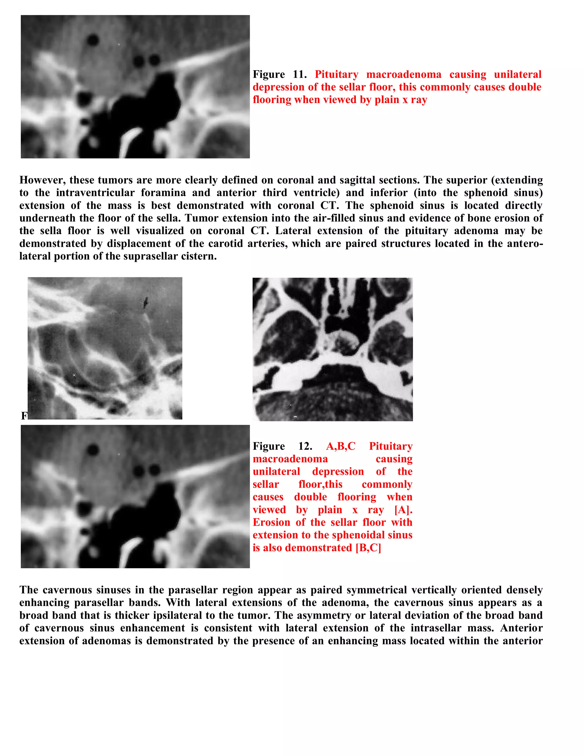 Topic of the month...Neuroimaging of pituitary adenomas