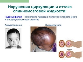 Нарушения циркуляции и оттока
    спинномозговой жидкости:
Гидроцефалия – накопление ликвора в полостях головного мозга
и в подпаутинном пространстве

Асимметричная                    Симметричная
 