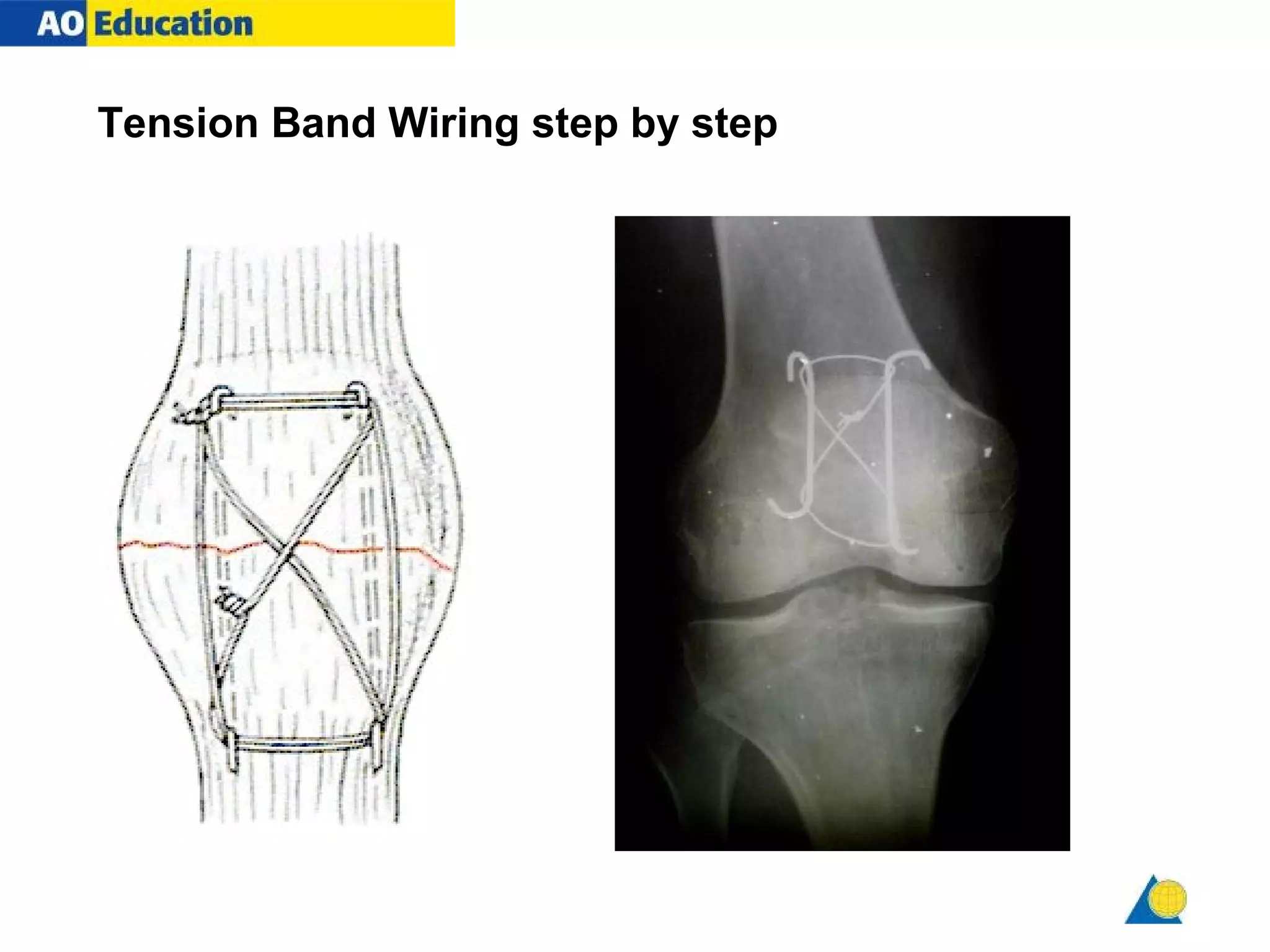 tension band wiring PPT