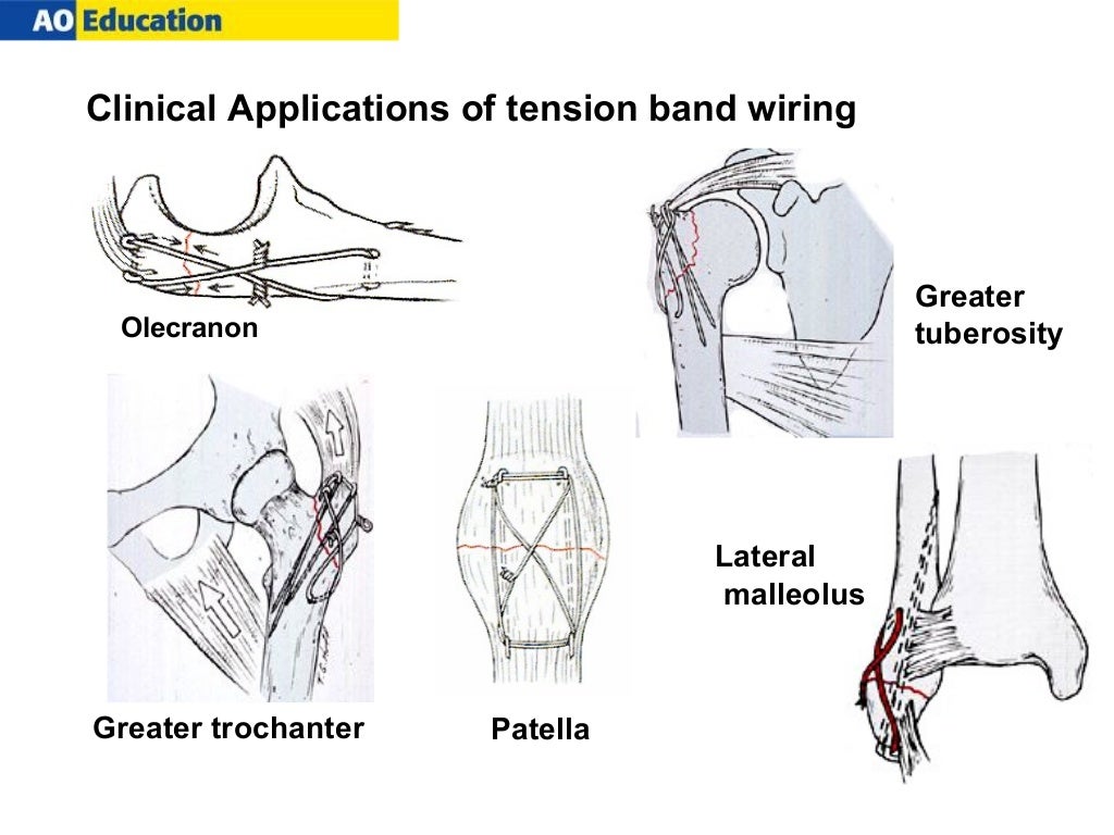 Knee Tension Band Wiring [pdf] Functional With Modif