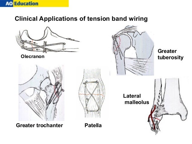 ao tension-band osteosynthesis of displaced olecranon fractures The gold standard for treating transverse olecranon fractures is tension band transverse fractures of the olecranon: a biomechanical comparison of three fixation. ao tension-band osteosynthesis of displaced olecranon fractures The gold standard for treating transverse olecranon fractures is tension band transverse fractures of the olecranon: a biomechanical comparison of three fixation.