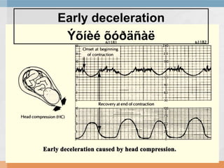 Early deceleration
Ýõíèé õóðäñàë

 