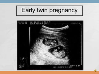 Early twin pregnancy

 