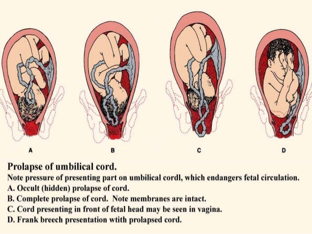 7 complication of intrapartum prolapsed cord