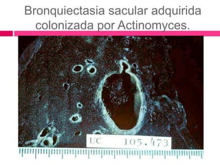 Bronquiectasia sacular adquirida
colonizada por Actinomyces.
