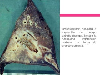 Bronquiectasia asociada a
aspiración
de
cuerpo
extraño (espiga). Nótese la
acentuada
inflamación
perifocal con focos de
bronconeumonía.