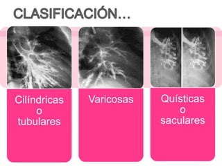 Cilíndricas
o
tubulares
Varicosas
Quísticas
o
saculares