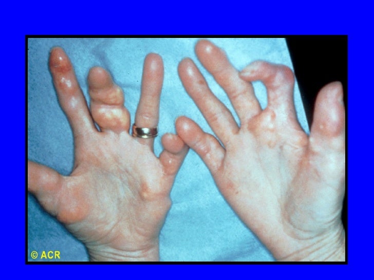 7 13 Connective Tissue Disease