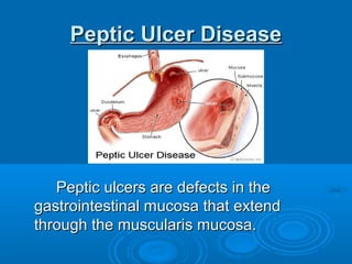 Peptic Ulcer Disease

Peptic ulcers are defects in the
gastrointestinal mucosa that extend
through the muscularis mucosa.

 