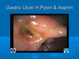 Gastric Ulcer H.Pylori & Aspirin

 