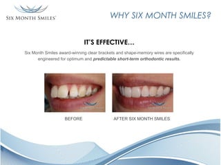 WHY SIX MONTH SMILES?
IT’S EFFECTIVE…
Six Month Smiles award-winning clear brackets and shape-memory wires are specifically
engineered for optimum and predictable short-term orthodontic results.

BEFORE

AFTER SIX MONTH SMILES

 