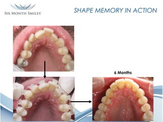 SHAPE MEMORY IN ACTION

6 Months

 