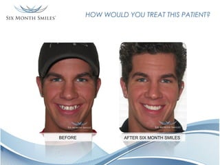 HOW WOULD YOU TREAT THIS PATIENT?

BEFORE

AFTER SIX MONTH SMILES

 