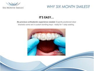 WHY SIX MONTH SMILES?
IT’S EASY…
No previous orthodontic experience needed. Expertly positioned clear
brackets come set in custom bonding trays - ready for 1-step seating.

 