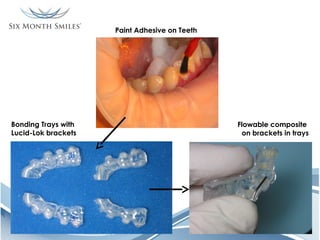 Paint Adhesive on Teeth

Bonding Trays with
Lucid-Lok brackets

Flowable composite
on brackets in trays

 