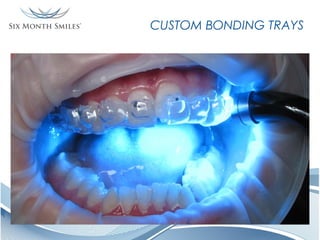 CUSTOM BONDING TRAYS

 