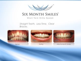 Straight Teeth. Less Time. Clear
Braces.

Before

During

After Six Month Smiles

 