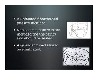 • All affected ﬁssures and
pits are included.

• Non carious ﬁssure is not
included the the cavity
and should be sealed.

• Any undermined should
be eliminated.

 