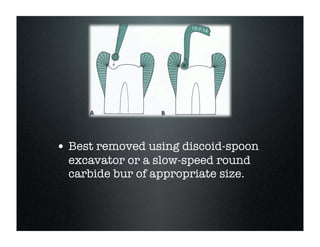 FIG
17-12 Removal of dentinal caries is accomplished with round burs (A) or
tors (B). C and D, Resistance form may be improved with flat floor peripheral to
or areas.

• Best less visible than on the pulpal floor. A caries-detecting
is removed using discoid-spoon
The removal of carious

solution may
helpful
excaexcavator beexplorerslow-speedmore re- fect resistance form becaus
or a in determining adequateroundfurther extension. In additi
vation. A sharp
or hand instrument is
liable than a rotating appropriate of rejudging
carbide bur ofbur inHowever,the adequacy size. tance form if the restoratio
moval of infected dentin.
these instruments
ripheral to the excavated
should be used judiciously in areas of possible pulpal
exposure.

should be at the previously
depth of 1.5 to 2 mm and in

 