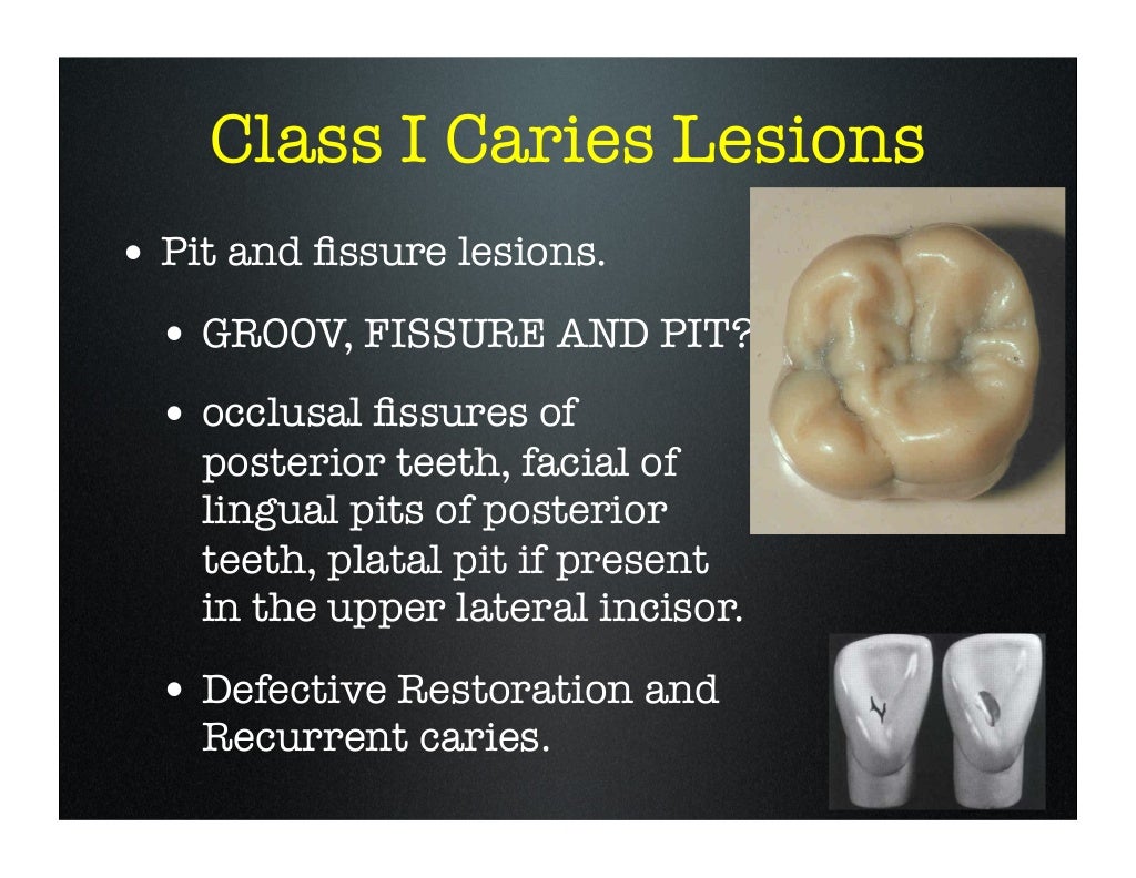 amalgam cavity preparation class i