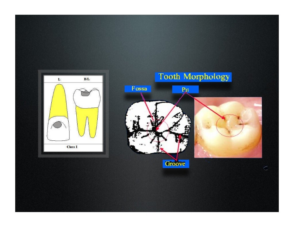 amalgam cavity preparation class i