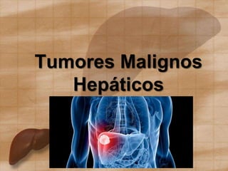 Tumores Malignos
Hepáticos
 