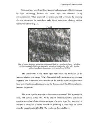Physiological Considerations
23
The smear layer was absent from specimens of demineralized teeth examined
by light microscopy because the smear layer was dissolved during
demineralization. When examined in undemineralized specimens by scanning
electron microscopy, the smear layer looks like an amorphous, relatively smooth,
featureless surface (Fig.12).
Fig. 12
Disc of human dentin cut with a fine grit diamond blade on a metallurgical saw. Half of the
specimen was etched with acid, leaving the smear layer intact on the other half. Note the
uniformity and amorphous nature of the smear layer. X 1560.
The constituents of the smear layer were below the resolution of the
scanning electron microscope (SEM). Transmission electron microscopy provided
important new information about the size of the particles constituting the smear
layer as well as their packing density and the dimensions of the diffusion channels
between the particles.
The smear layer increases the resistance to movement of fluid across dentin
discs, both in vivo and in vitro. As the rates of filtration provide a convenient,
quantitative method of assessing the presence of a smear layer, they were used to
compare a variety of different methods of producing a smear layer on dentin
etched with acid in vitro (Fig.13). The results are shown in Fig.14.
 