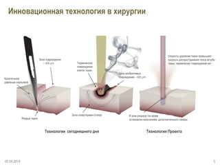 5
Инновационная технология в хирургии
05.04.2014
Технология ПроектаТехнологии сегодняшнего дня
Скорость удаления ткани превышает
скорость распространения тепла вглубь
ткани, термических повреждений нет
Касательное
давление скальпеля
Зона повреждения
> 400 µm Термическое
повреждение
клеток ткани
Зона необратимых
повреждений > 600 µm
Зона гипертермии (отека)
Разрыв ткани
В зоне разреза ток крови
остановлен излучением дополнительного лазера
 