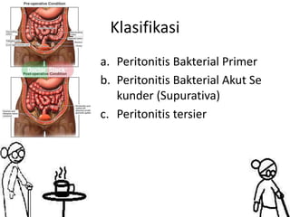 Klasifikasi
a. Peritonitis Bakterial Primer
b. Peritonitis Bakterial Akut Se
kunder (Supurativa)
c. Peritonitis tersier
 