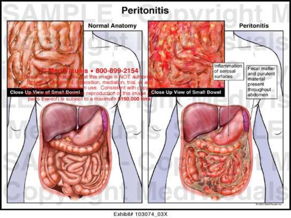 7 peritonitis 7 peritonitis