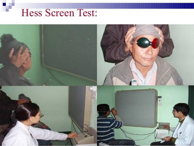 eye test letters Motor evaluation of strabismus eye test letters Motor evaluation of strabismus