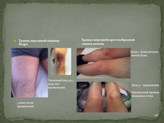 Причины спортивного травматизма, концепция происхождения травм и НС профилактика травматизма в сборных командах РФ