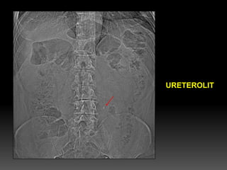 URETEROLIT  