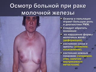 ООссммооттрр ббооллььнноойй ппррии ррааккее 
ммооллооччнноойй жжееллееззыы 
ООссммооттрр ии ппааллььппаацциияя 
ииггррааюютт ббооллььшшууюю рроолльь 
вв ддииааггннооссттииккее РРММЖЖ.. 
ССллееддууеетт ооббррааттииттьь 
ввннииммааннииее: 
ннаа ннаарруушшееннииее ффооррммыы 
ммооллооччнныыхх жжееллёёзз 
((ддееффооррммаацциияя)),, 
ссооссттоояяннииее ссооссккаа ии 
ааррееооллыы ((ввттяяжжееннииее,, 
ииззъъяяззввллееннииее)),, 
ссооссттоояяннииее ккоожжнныыхх 
ппооккррооввоовв ((ггииппееррееммиияя,, 
ооттёёкк,, ннааллииччииее 
ввннууттррииккоожжнныыхх 
ммееттаассттааззоовв)).. 
 