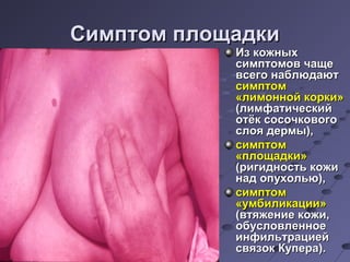 ССииммппттоомм ппллоощщааддккии 
ИИзз ккоожжнныыхх 
ссииммппттооммоовв ччаащщее 
ввссееггоо ннааббллююддааюютт 
ссииммппттоомм 
«ллииммоонннноойй ккооррккии» 
((ллииммффааттииччеессккиийй 
ооттёёкк ссооссооччккооввооггоо 
ссллоояя ддееррммыы)),, 
ссииммппттоомм 
«ппллоощщааддккии» 
((ррииггииддннооссттьь ккоожжии 
ннаадд ооппууххооллььюю)),, 
ссииммппттоомм 
«ууммббииллииккааццииии» 
((ввттяяжжееннииее ккоожжии,, 
ооббууссллооввллееннннооее 
ииннффииллььттррааццииеейй 
ссввяяззоокк ККууппеерраа)).. 
 