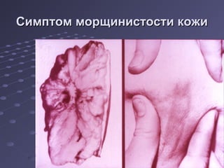 ССииммппттоомм ммооррщщииннииссттооссттии ккоожжии 
 